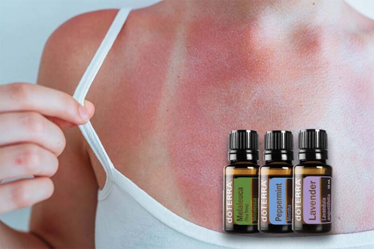 Napégés kezelése doTERRA illóolajokkal