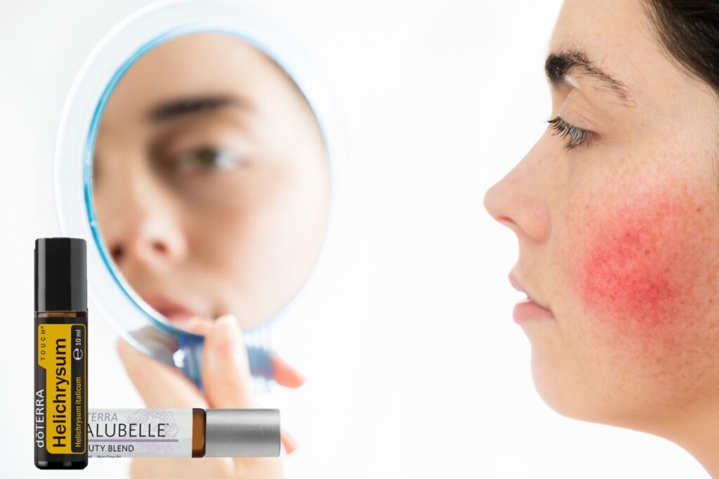 Illóolajok szerepe a rosacea tüneteinek enyhítésében